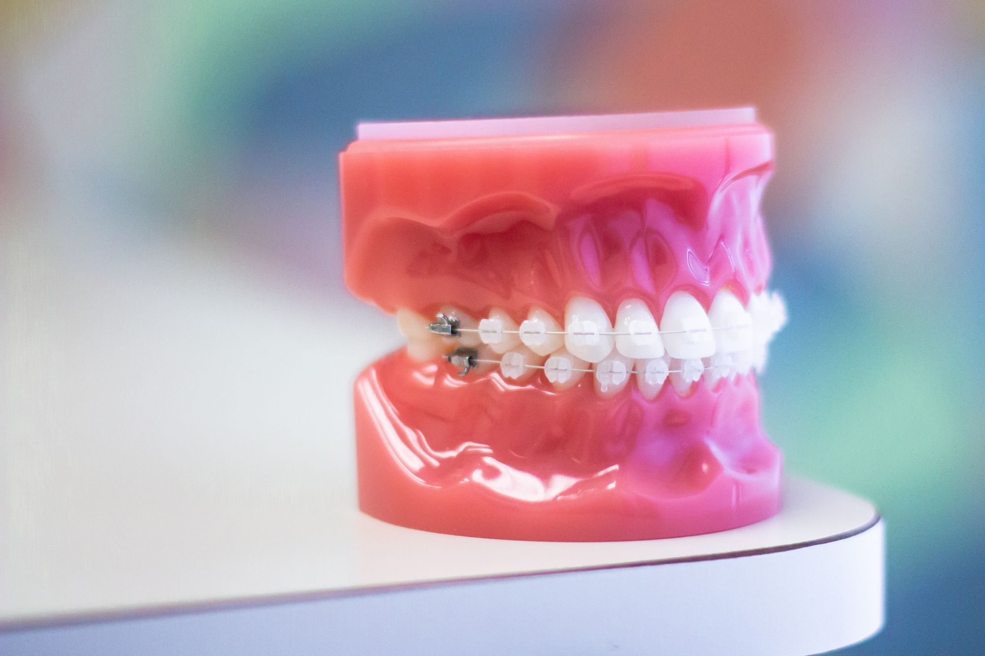 Clear braces on teeth model