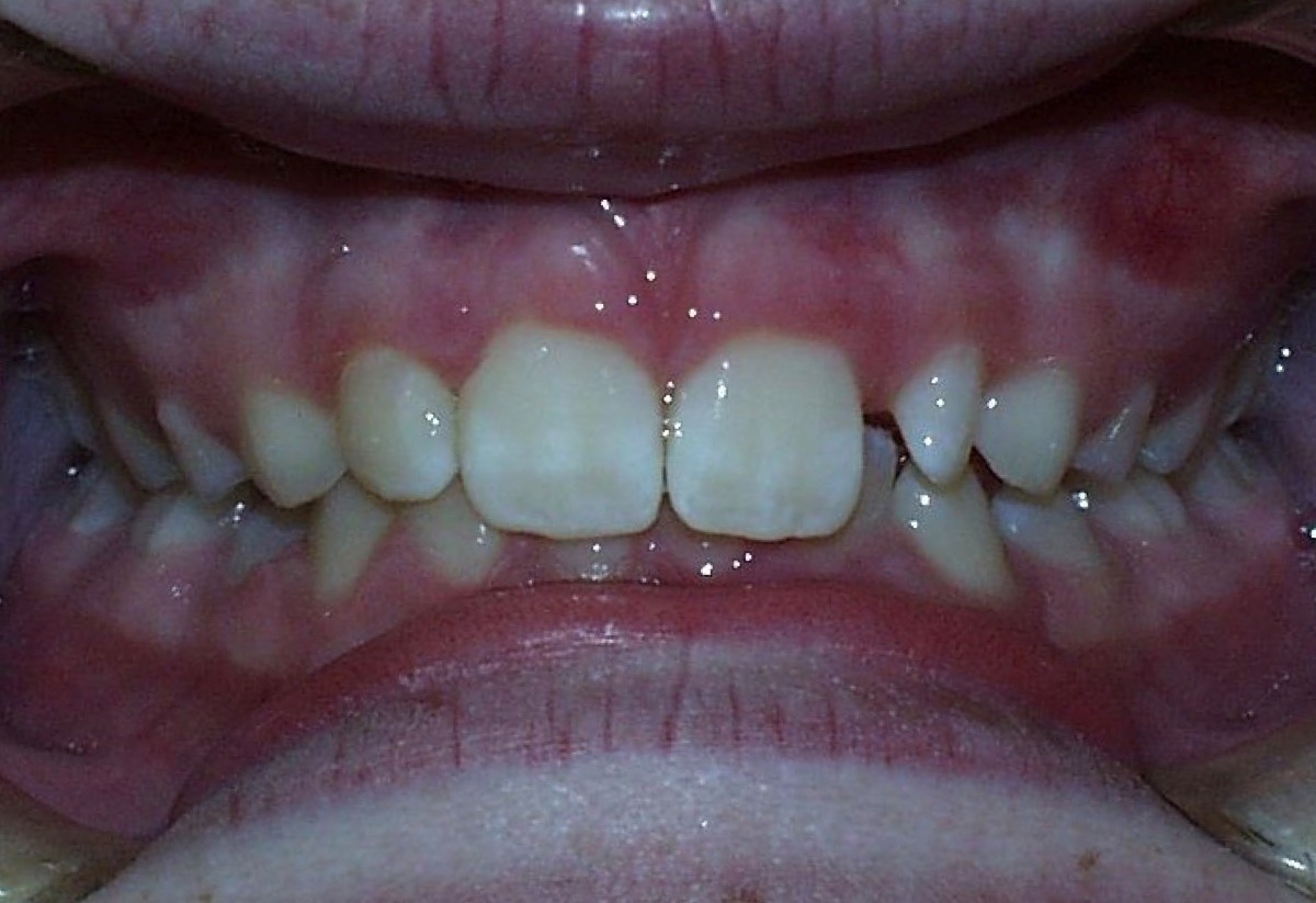 smiling patient before orthodontics