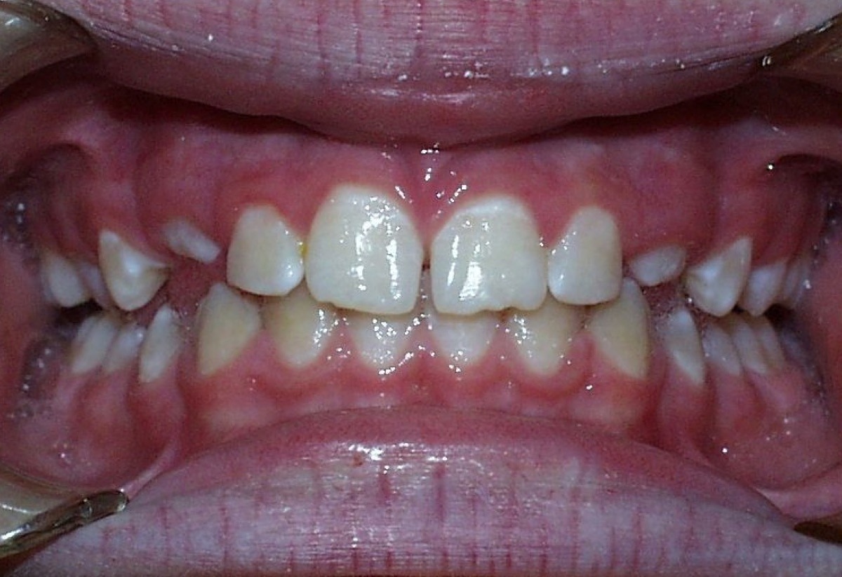 smiling patient before orthodontics
