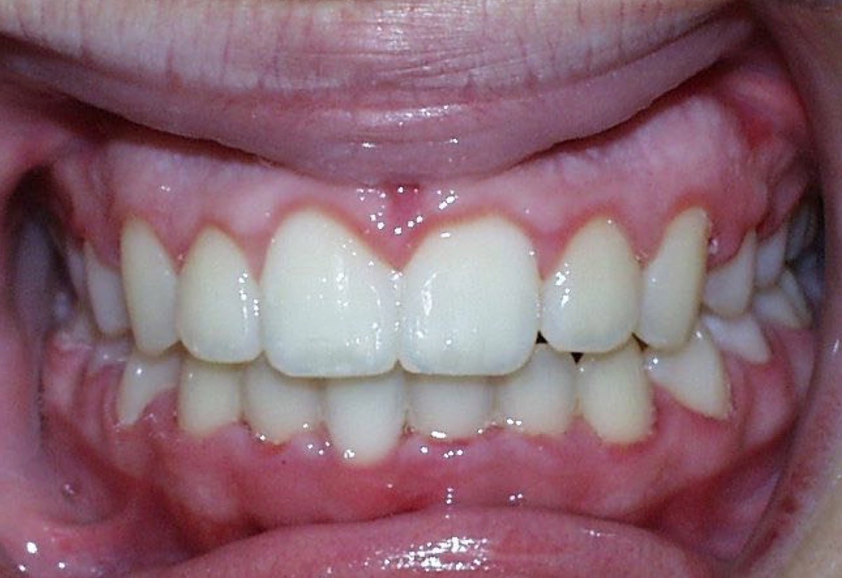 smiling patient after orthodontics