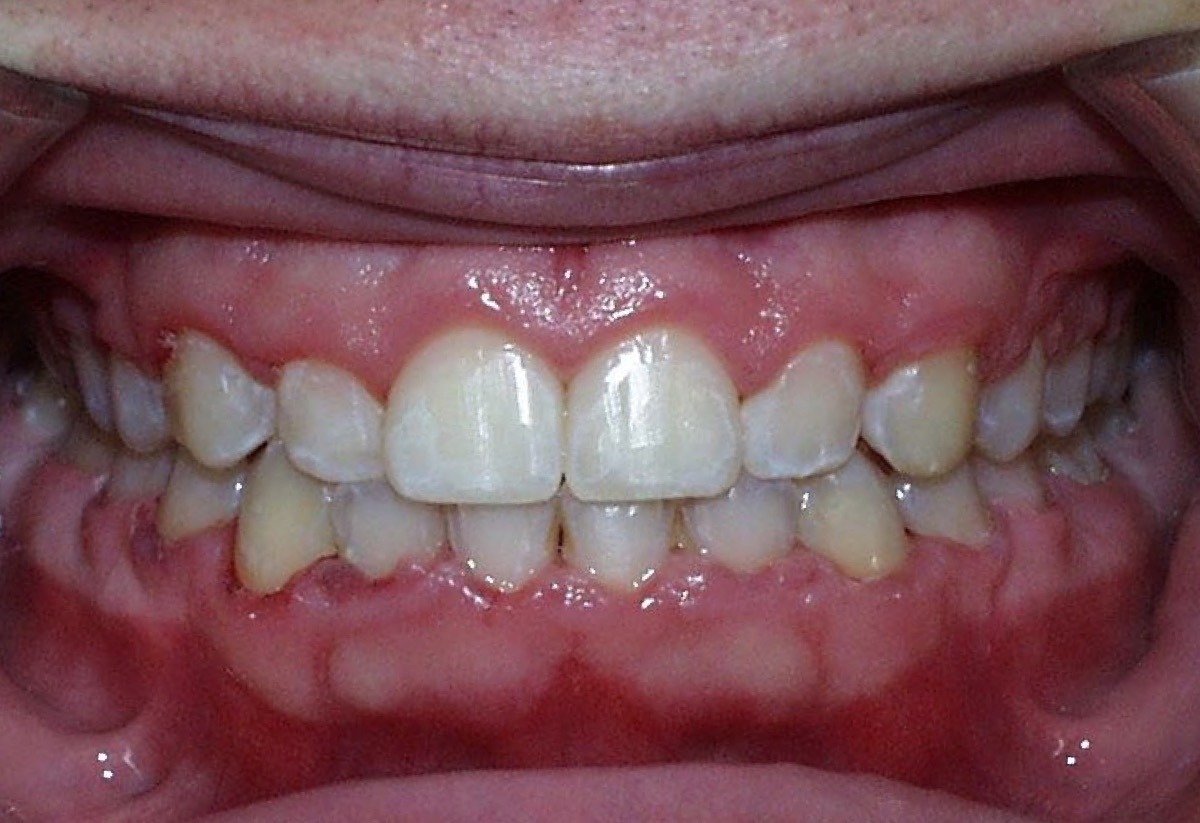 smiling patient after orthodontics