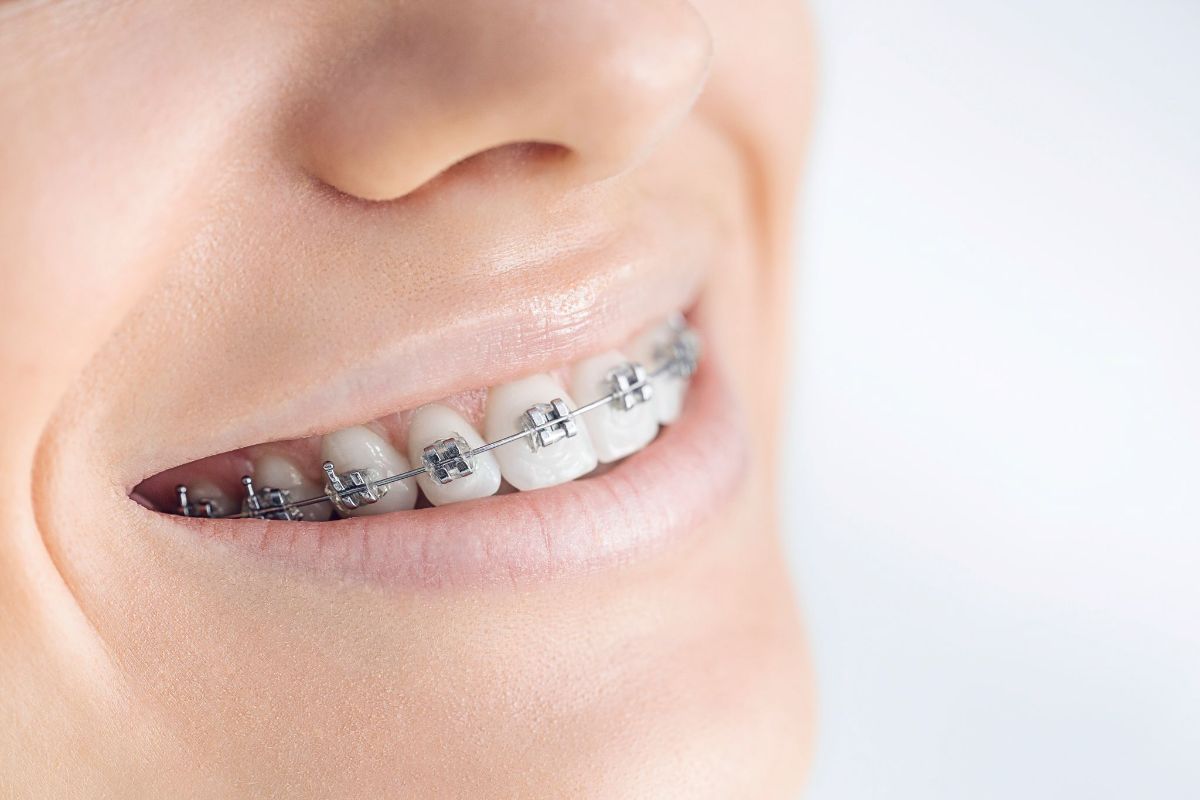 Need more info about palatal expanders? Come see us for all the answers you need!