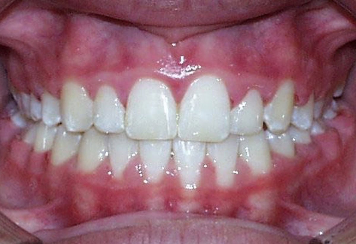 Frontal Intraoral