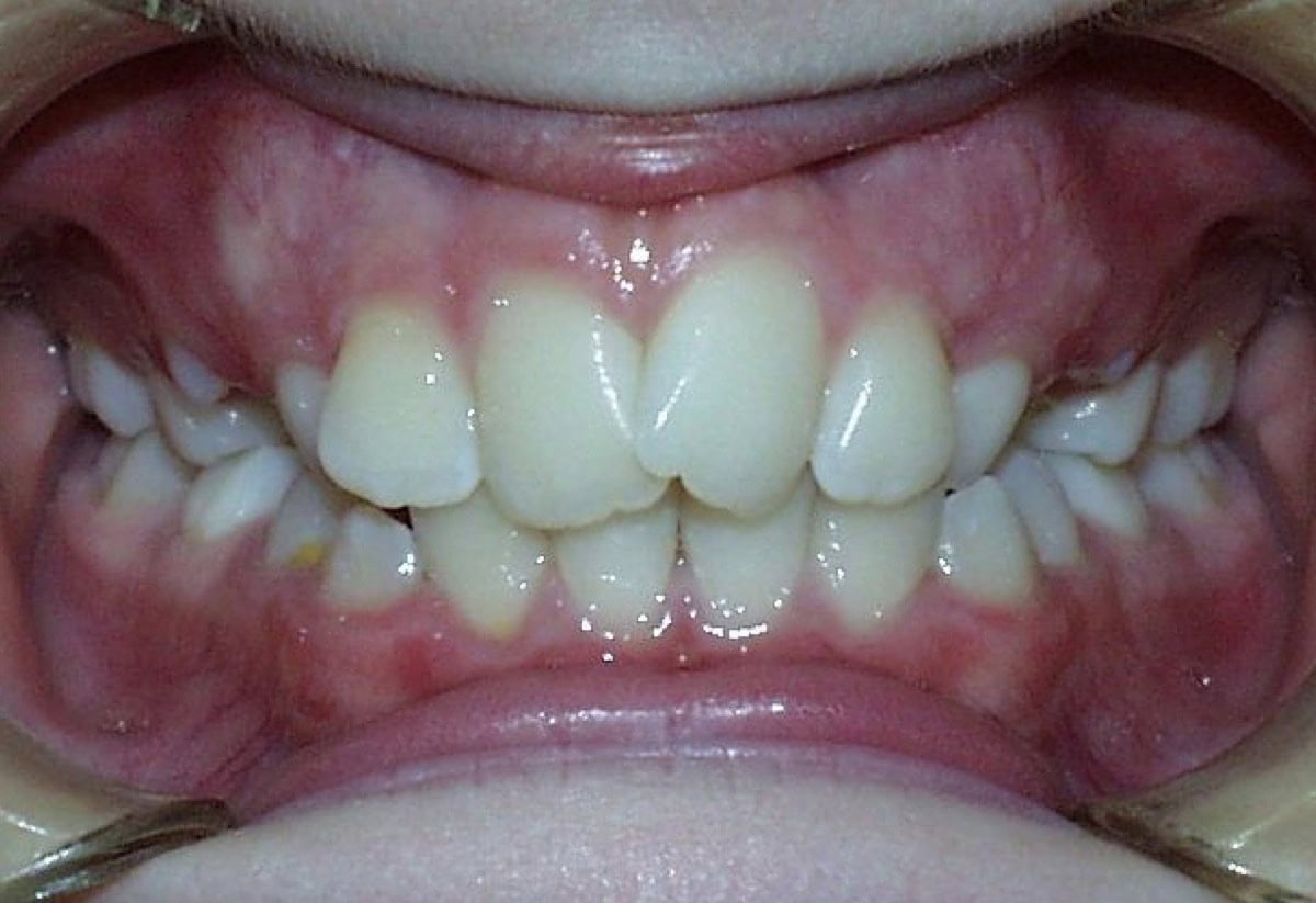 Frontal Intraoral