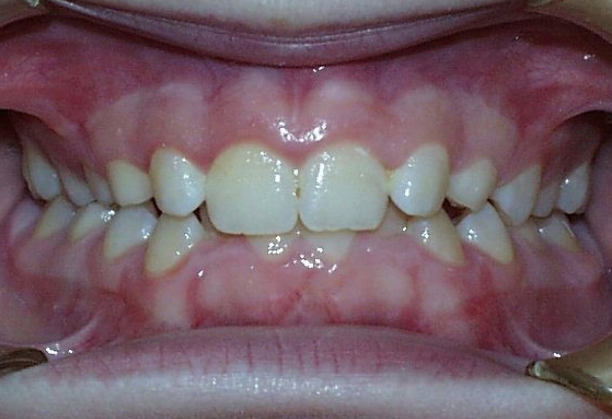 Frontal Intraoral