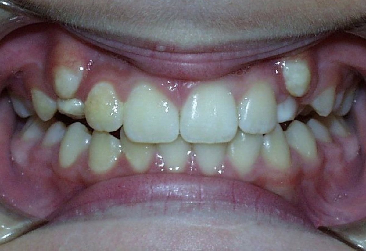 Frontal Intraoral