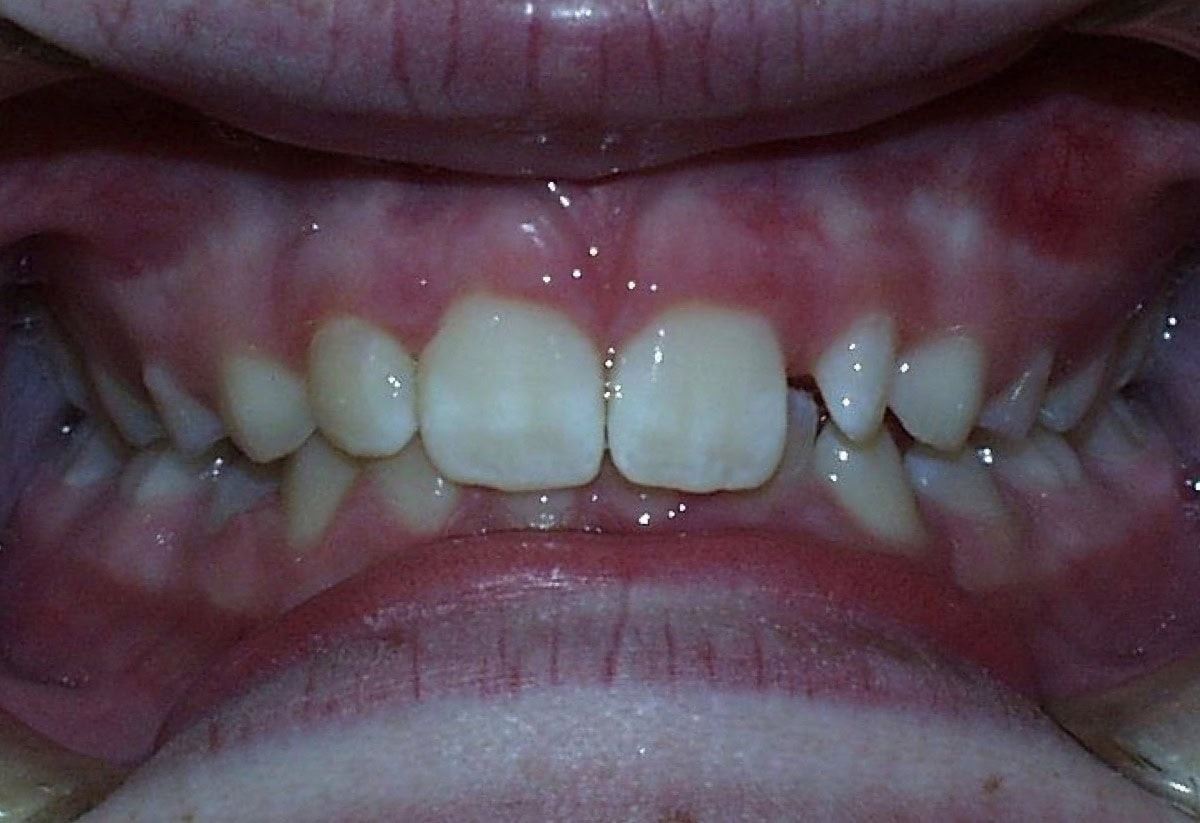 Frontal Intraoral