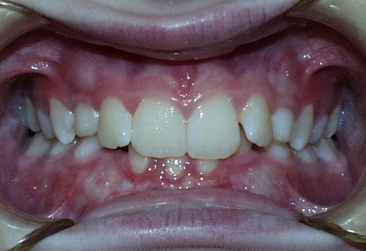 Frontal Intraoral