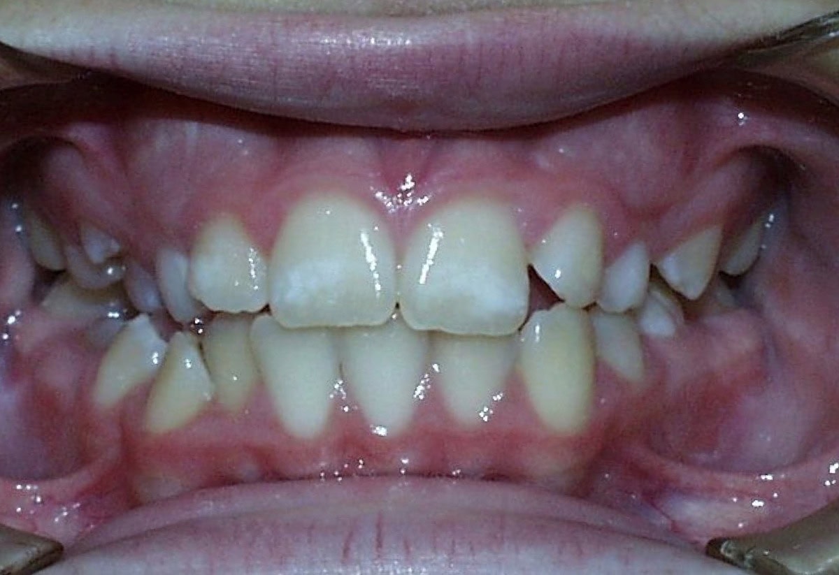 Frontal Intraoral