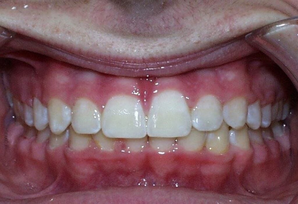 Frontal Intraoral