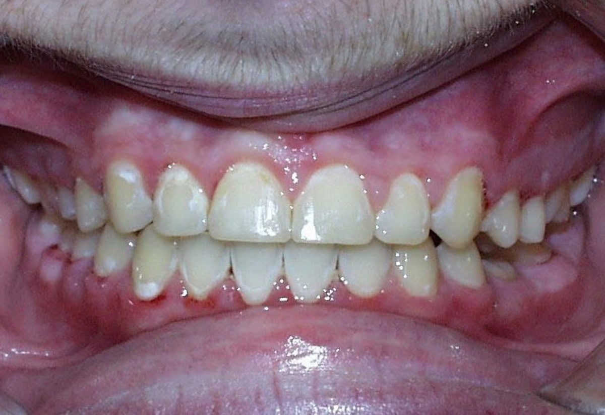 Frontal Intraoral