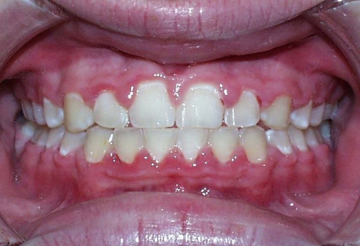 Frontal Intraoral