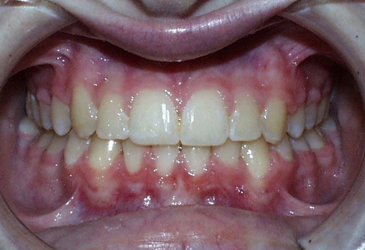 Frontal Intraoral