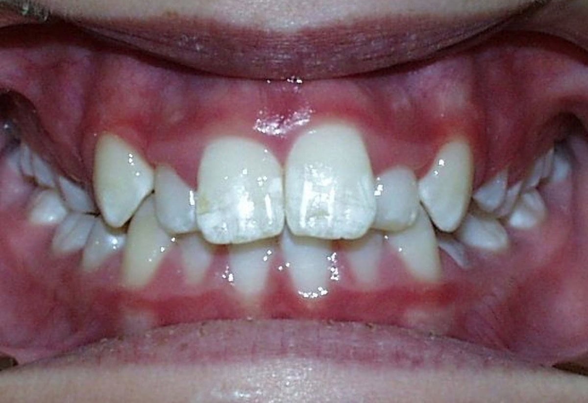 Frontal Intraoral