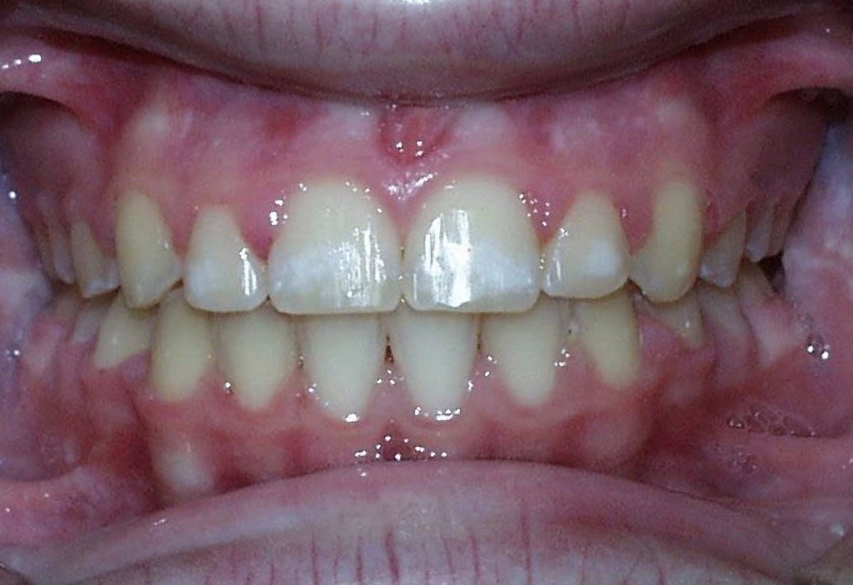 Frontal Intraoral