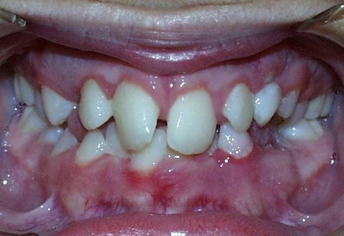 Frontal Intraoral