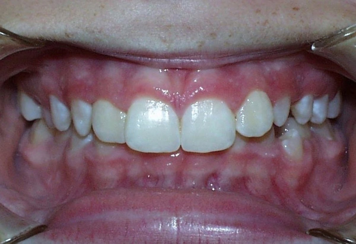 Frontal Intraoral