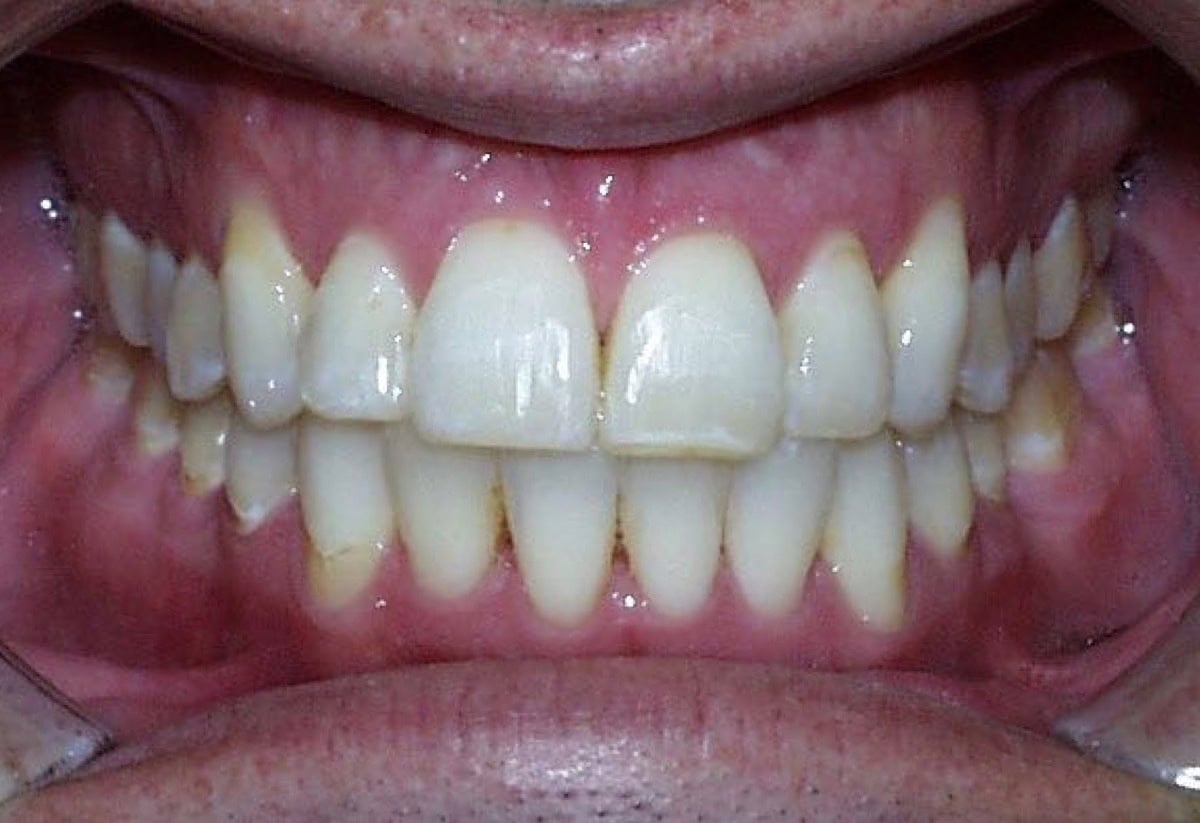 Frontal Intraoral