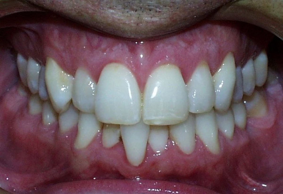 Frontal Intraoral