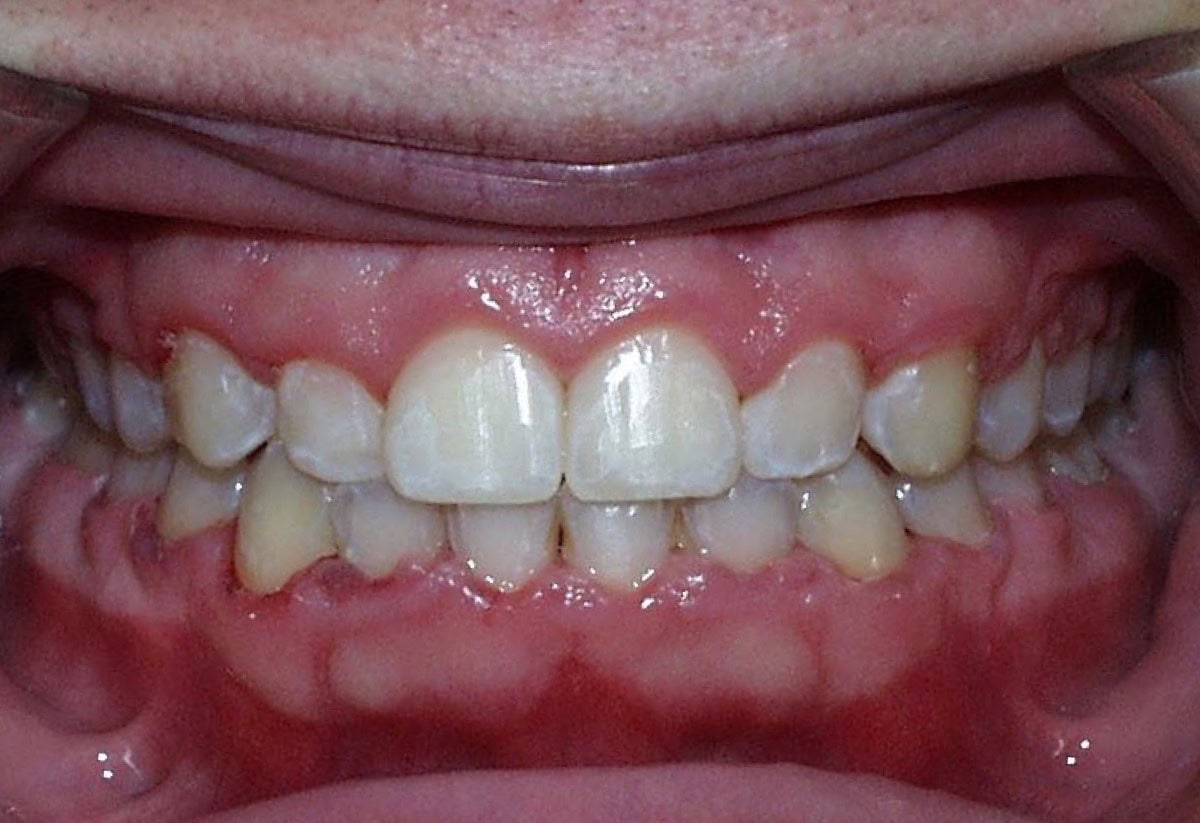 Frontal Intraoral