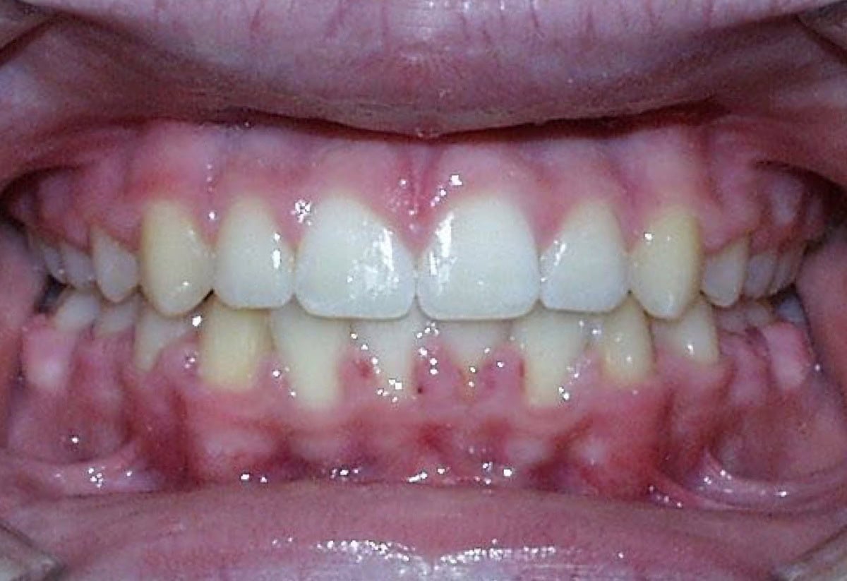 Frontal Intraoral