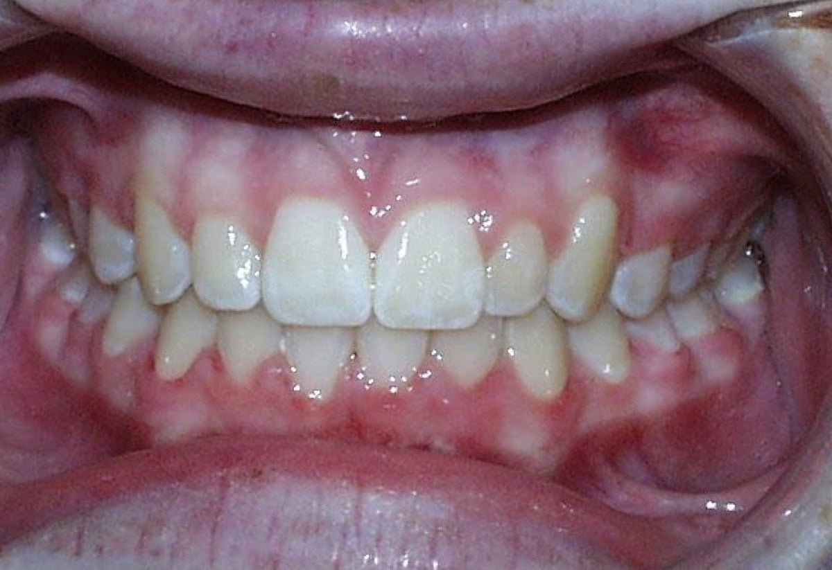 Frontal Intraoral