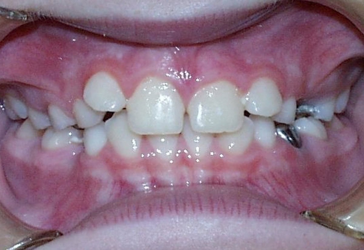 Frontal Intraoral